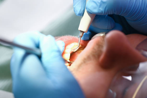 Best Emergency Root Canal Treatment in Tuckahoe, NY